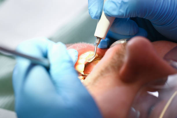 Best Emergency Broken Tooth Repair in USA